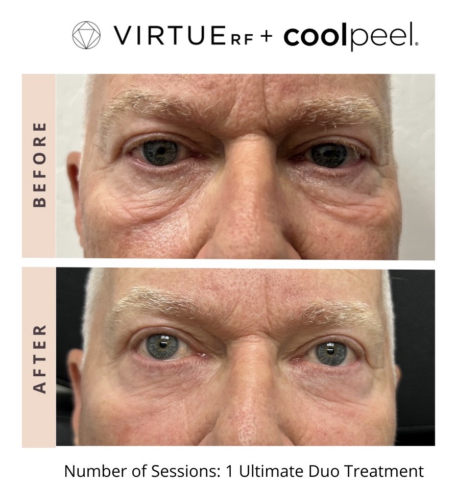 Kauai-Medspa_CoolPeel Before After a in Hawaii