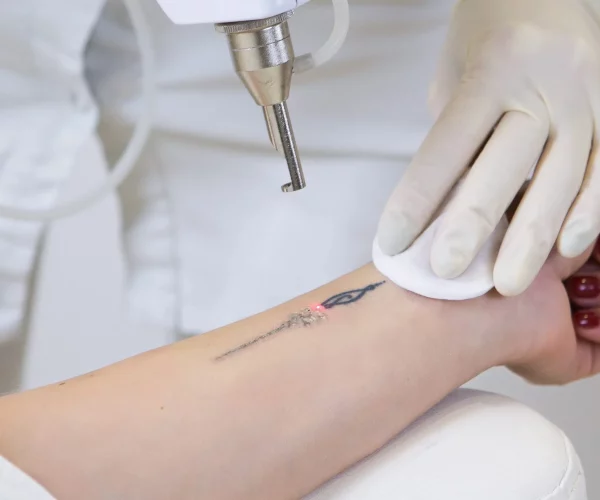 Tattoo Removal