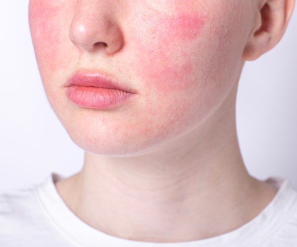 rosacea couperose redness skin, red spots on cheeks, young woman with sensitive skin, patient face close-up